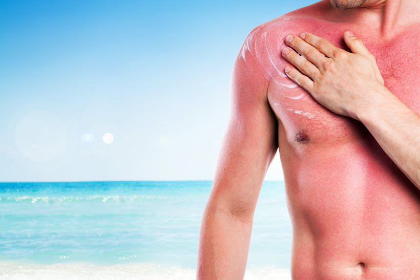 sunburn